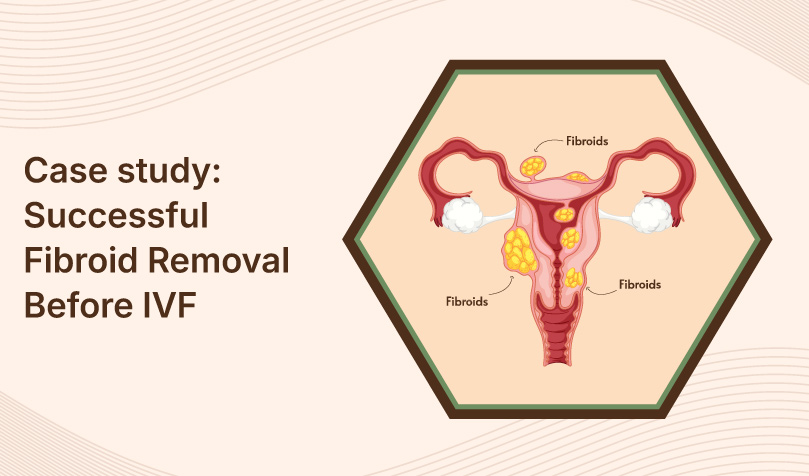 Case-study---Successful-Fibroid-Removal-Before-IVF